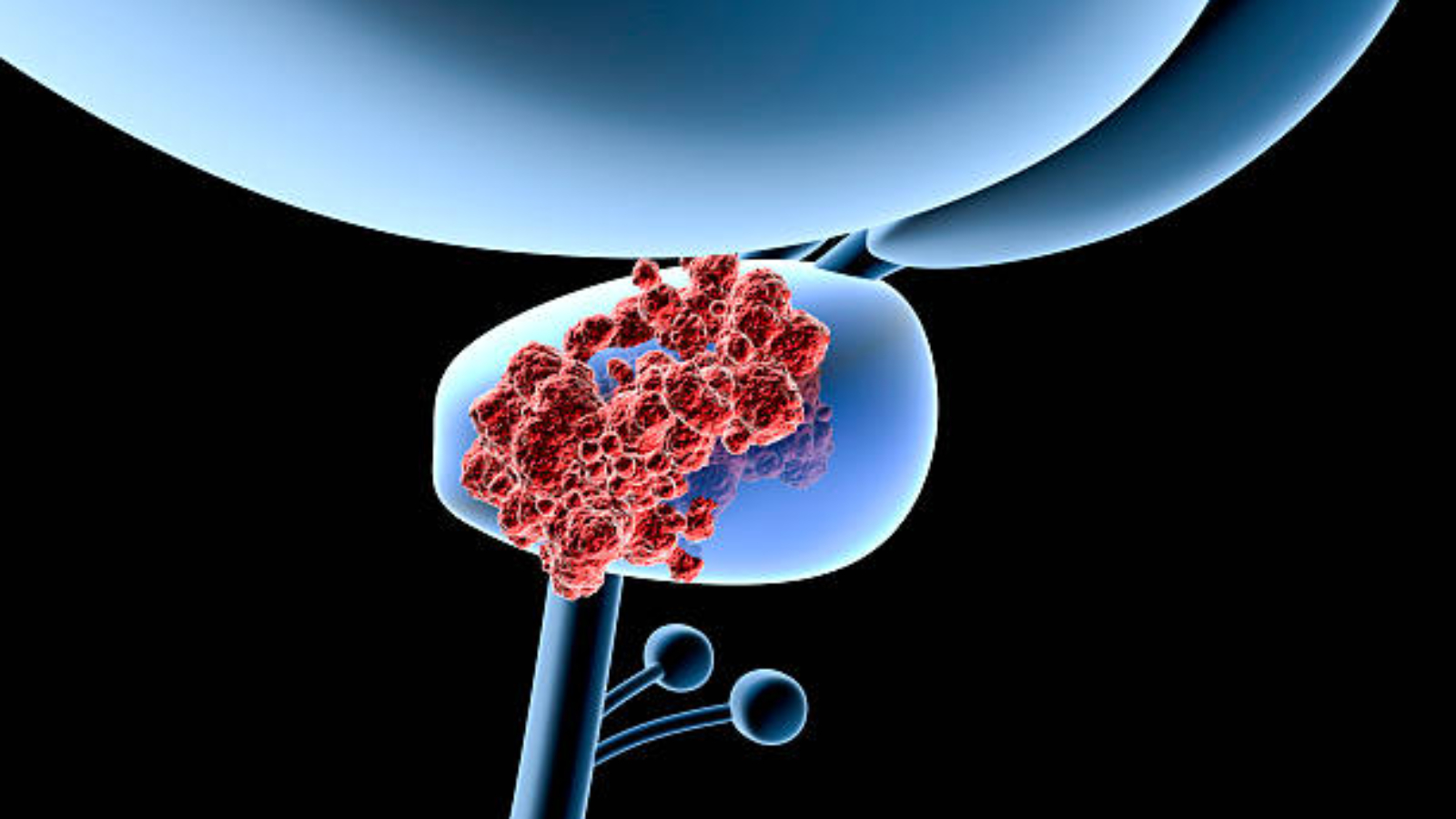 Lazer Prostat Ameliyatı