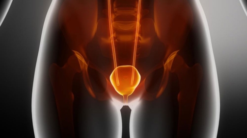 Mesane Kanseri Belirtileri