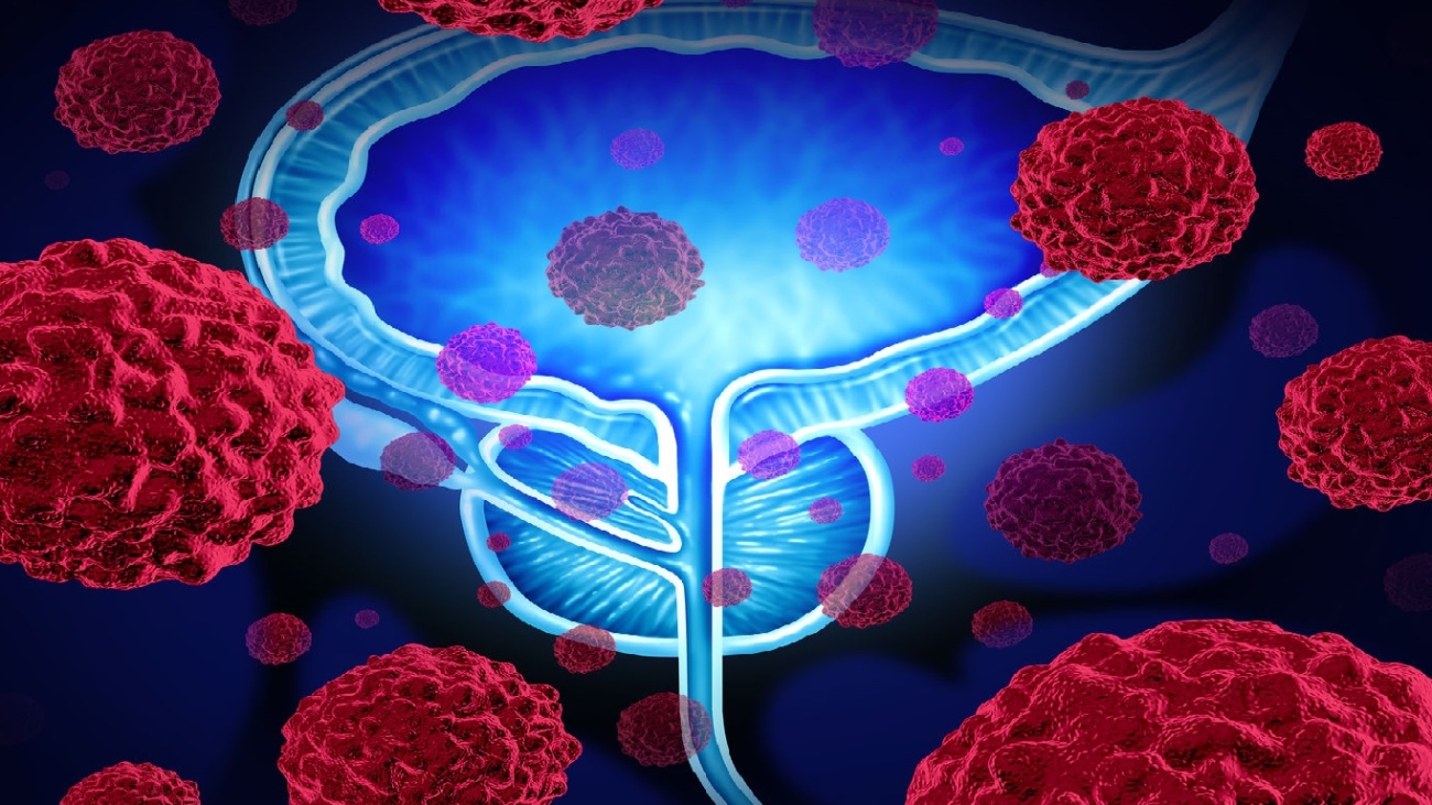 Mesane Kanseri Tedavisi